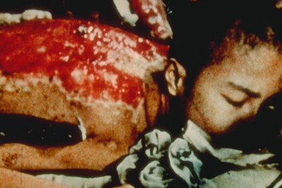 Child Burned by Atom Bomb Blast