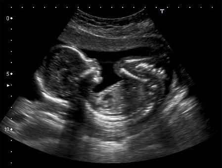 Pregnant-Ultrasound